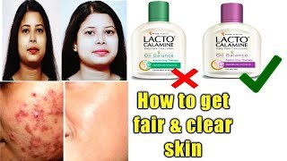 Lacto Calamine lotion reviewusesbenefitshow to get clear and fair skin [upl. by Millie293]