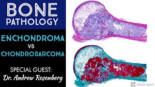 Chondrosarcoma vs Enchondroma Bone Pathology with Dr Andrew Rosenberg [upl. by Jacobine]