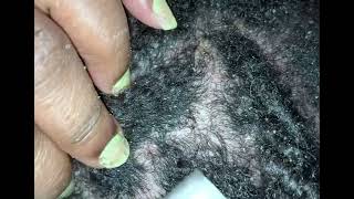 Dandruff scratching 2024 subscribe vlog scratching [upl. by Yttiy]