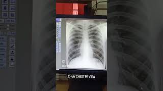 CHEST XRAY PA VIEW PRINT LAYOUT xray xraytechnician xrays radiology [upl. by Icram]