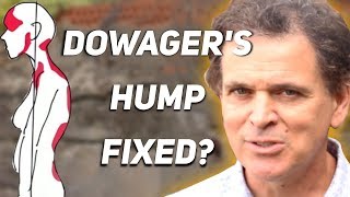 How To Fix Dowagers Hump [upl. by Schofield879]