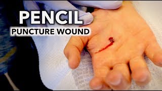 HE STABBED HIS HAND WITH A PENCIL puncture wound  Dr Paul [upl. by Pascoe]