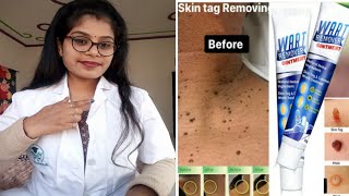 Wart Remover Ointment Wart Remover honest review  Wart Remover Cream benefits uses review in hindi [upl. by Oona936]