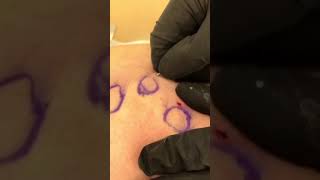 Cellulite removal treatment with manual subcision and Radiesse injection [upl. by Grishilda]