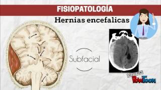 Fisiopatología de los tumores cerebrales [upl. by Abbie]