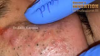 BLACKHEADS REMOVAL BY DR LALIT KASANA [upl. by Gass252]