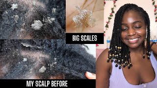 How I cleared Seborrheic Dermatitis amp Healed my scalp NOT SPONSORED  Giveaway [upl. by Aramas]