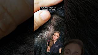 Get Rid Of Scalp Build Up [upl. by Marka]