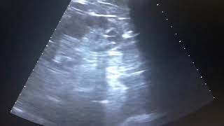 Renal lithiasis Ultrasound Litiasis renal Ecografia [upl. by Mahalia]