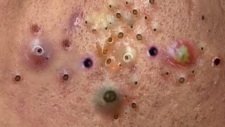 blackheads new 2023  popping pimple  acne and whiteheads removal [upl. by Naitsabas759]