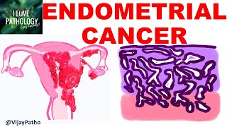 ENDOMETRIAL CARCINOMA Risk factors Etiopathogenesis Morphology amp Clinical features [upl. by Burtis]