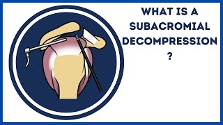 What is a subacromial decompression [upl. by Laurentia]