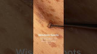 Technically called Seborrheic Keratosis shorts skintreatment skingrowth moleremoval agespot [upl. by Nickerson783]