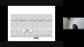 cardiotocography [upl. by Lamberto113]