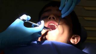 Tooth filling in school dental clinic Part 2 Tooth filling [upl. by Allets]