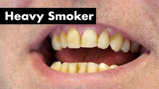 Cleaning Smokers Teeth with Heavy Stain  Teeth Cleaning [upl. by Alexio]