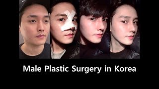 Male Eyelid Surgery and Rhinoplasty in Korea [upl. by Mistrot]