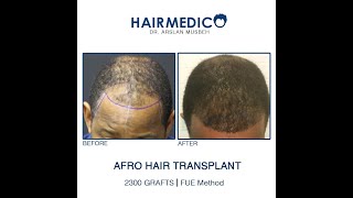 AFRO Hair Transplant  Before and After  Dr Arslan Musbeh [upl. by Navonod583]