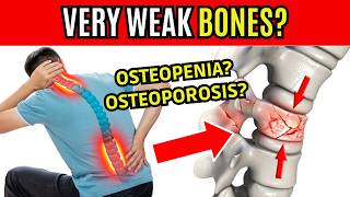 5 TIPS TO IMPROVE OSTEOPENIA and OSTEOPOROSIS  SYMPTOMS OF WEAK BONES [upl. by Ssac231]