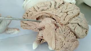 Lateral ventricle of BrainNeuroanatomy [upl. by Hodosh]