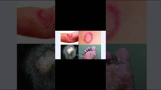 Fungal infection in Private Parts  Get Rid Of Itching In Private Parts  Treatment in Urdu  Hindi [upl. by Palgrave]