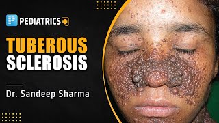 Tuberous Sclerosis by Dr Sandeep Sharma  PrepLadder NEET SS [upl. by Haila321]