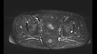 Ischial bursitis [upl. by Burgess]