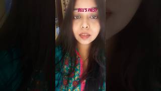 SUFFERING from Facial Paralysis  Belly Palsy [upl. by Nessa]