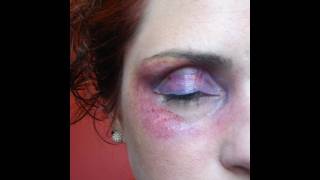 Swollen Black Eye Makeup Tutorial [upl. by Barney]