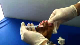 Incision and Drainage of abscess drenagem de abscesso Abscess [upl. by Nhguavaj]