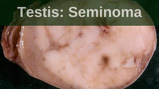 Testicular germ cell tumours  Seminoma  Pathology mini tutorial [upl. by Rovner]