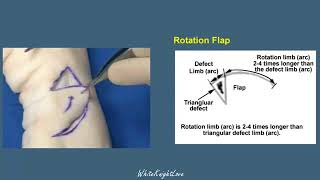 8 3 Rotation Flap Skin Flaps Essential Surgical Skills WhiteKnightLove [upl. by Adiene]