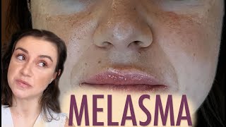 Como tratar MELASMA no rosto  Opinião de Esteticista melasma tratamentoparamelasma [upl. by Latsyrhc448]