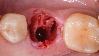 Immediate Implant Placement Mandibular Molar [upl. by Analim]