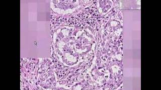 Histopathology LungAdenocarcinoma [upl. by Ansley]