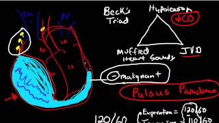 Oncologic Emergencies Cardiac Tamponade [upl. by Ennovaj937]