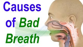 Sources of Bad Breath or Halitosis Evaluate Diagnose and Treat [upl. by Arny368]