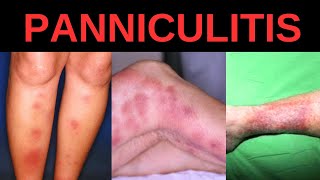 WHAT IS PANNICULITIS SYMPTOMS CAUSES TREATMENT [upl. by Arais]