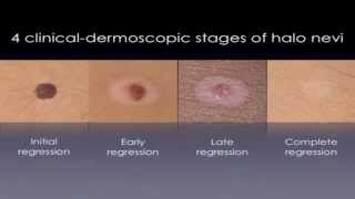 Halo Nevus  White Circles On Skin TREATMENT [upl. by Head]