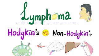 Hodgkin’s Lymphoma vs NonHodgkins Lymphoma  Comparison  Hematology and Oncology [upl. by Deys]