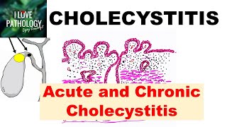 CHOLECYSTITIS Acute and Chronic Pathology and Complications [upl. by Filahk]