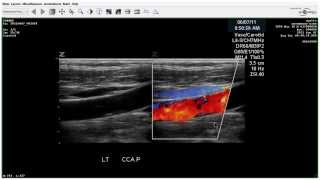 Carotid Duplex Total Occlusion Case Study [upl. by Essilevi640]