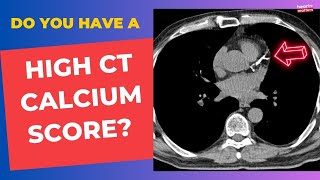 High Calcium Score What Next [upl. by Wilterdink]