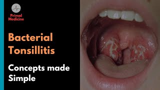 Bacterial Tonsillitis Centor Criteria and FeverPAIN Score [upl. by Lertsek]