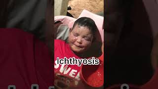 Ichthyosis skincare Ichthyosis eczema [upl. by Engedus482]