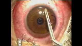 Lasik Laser Eye Surgery Procedure  Live Surgery [upl. by Nuahsad606]