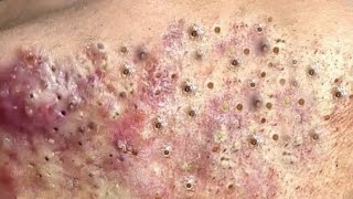 Popping huge blackheads and PimplePopping Best Pimple Popping Videos 10 [upl. by Ail]