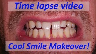 Time lapse of Dental Composite Veneers to close gaps [upl. by Danby]