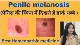 Penile melanosis  पेनिस की स्किन में डार्क धब्बे  Penile melanosis symptomscauses amp medicines [upl. by Yursa]