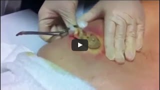 Biggest Pimple Pop Ever Caught On Camera Guiness World Record [upl. by Anatak143]